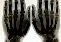 Two_hands,_viewed_through_x-ray._Photoprint_from_radiograph_Wellcome_V0029554_(improved_contrast)