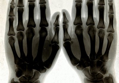 Two_hands,_viewed_through_x-ray._Photoprint_from_radiograph_Wellcome_V0029554_(improved_contrast)