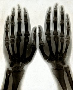 Two_hands,_viewed_through_x-ray._Photoprint_from_radiograph_Wellcome_V0029554_(improved_contrast)